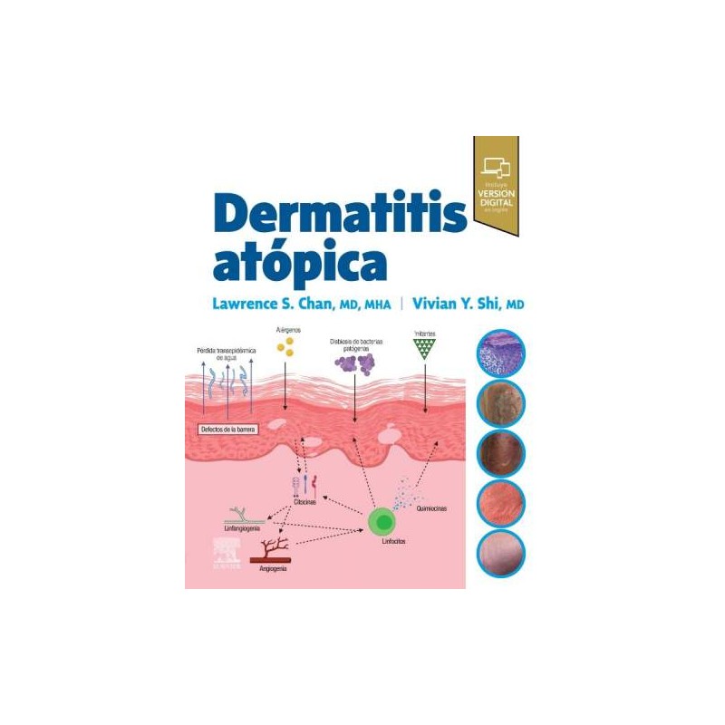 Dermatitis Atópica