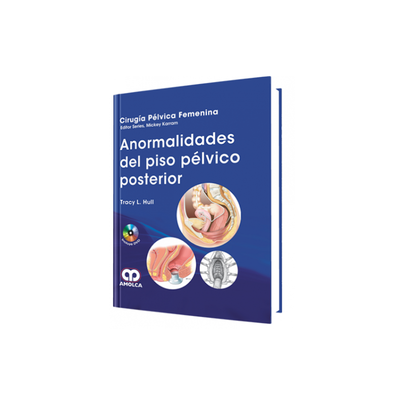 Anormalidades del Piso Pélvico Posterior