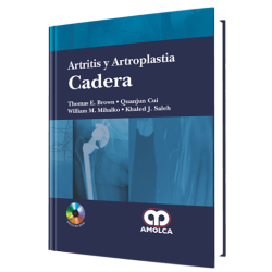 Artritis y Artroplastia Cadera